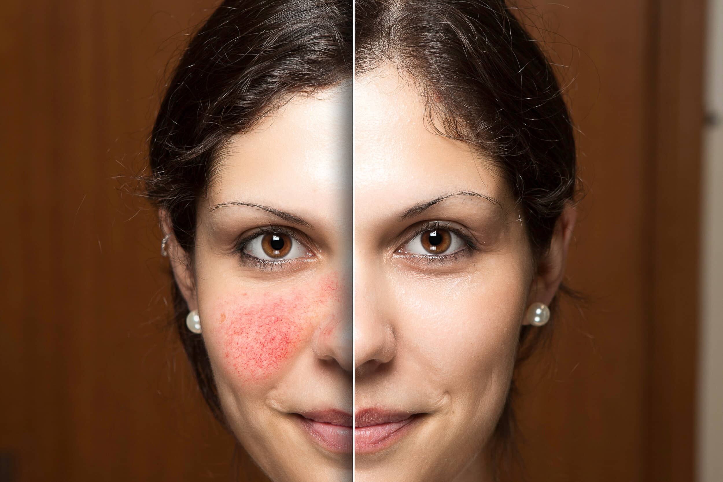 Before and after comparison showing significant reduction of facial redness after treatment
