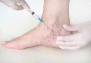 Doctor performs sclerotherapy for spider veins in GA